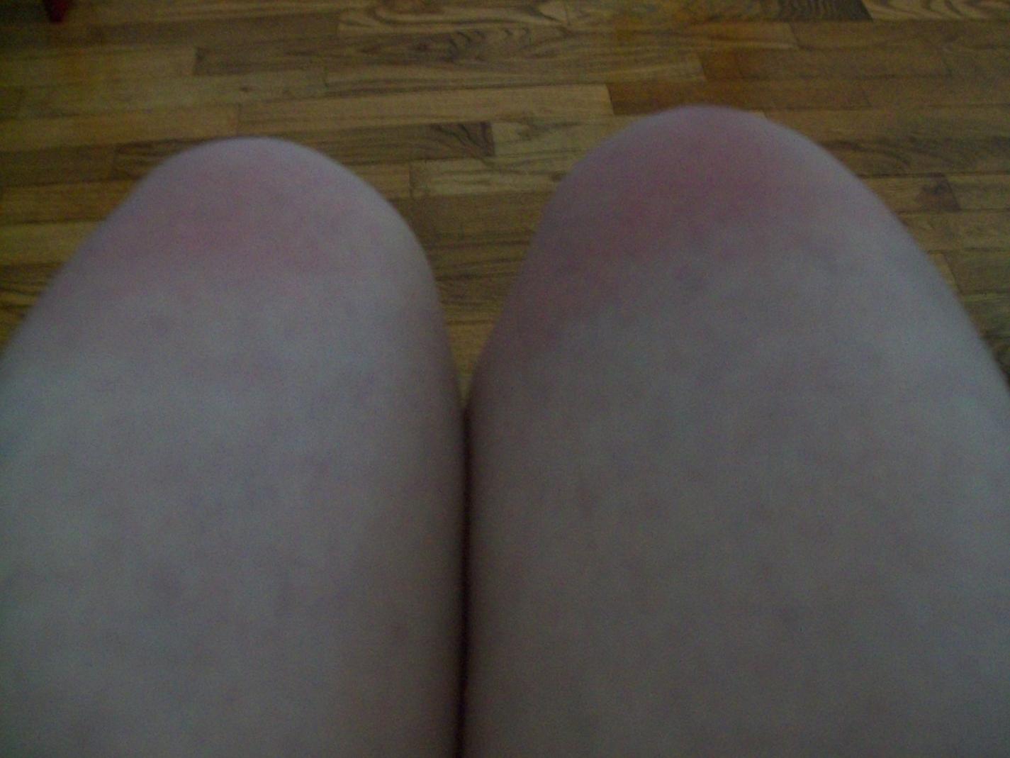Both Knees Sunburned-sunburned-knees-020-jpg